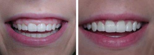 periodontics endodontics specialist dr stephanie mullins dds lee summit mo Crown lengthening Before After